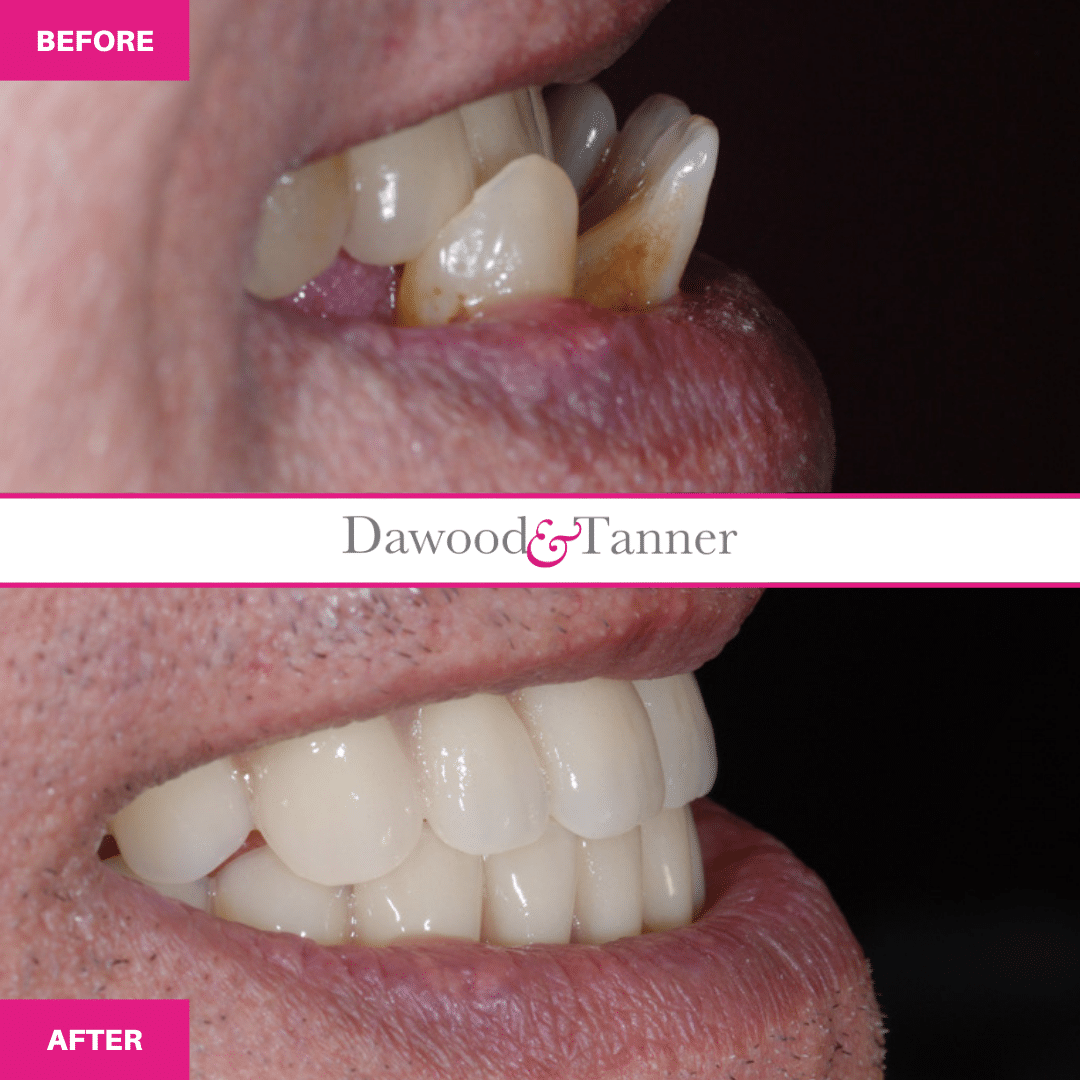 All on four Dental Implants at Dawood and Tanner